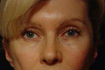 COSMETIC EYELID SURGERY